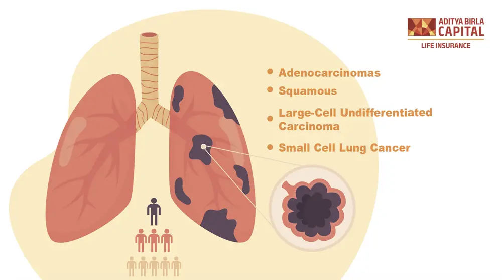 Types of lung cancer